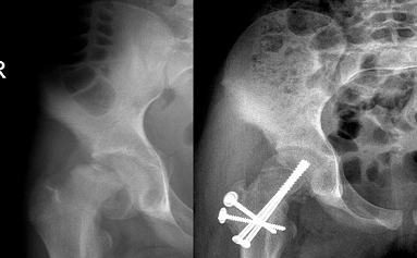 Doç. Dr. Güney YILMAZ, Serebral Palsi, Doğumsal Kalça Çıkığı, Gelişimsel Kalça Displazisi, Pavlik Bandaj Tedavisi, Kapalı/Açık Tedaviler, Ganz Osteotomisi, Femur Başı Epifiz Kayması, Perthes Hastalığı, Bacak Şekil Bozukluklarının Düzeltilmesi, Eksternal Fiksatörler, Kelepçe Sistemi, Büyüme Yönlendirme, Plak ve Vida Kullanımı, Kemik İçi Çivi Kullanımı, Bacak/Boy Uzatma Cerrahileri, Eksternal Fiksatörler, Kemik İçinden Manyetik Çivi, Pesekinovarus, Doğumsal Çarpık Ayak, Ponseti Yöntemi, Ayak Abdüksiyon Ortezi, Tendon Transferi, Düz Tabanlık, Osteogenesis İmperfekta, Cam Kemik Hastalığı, Teleskopik Çivi Uygulaması, Spina Bifida, İskelet Displazileri, Çocukluk Çağı Kas İskelet Sistemi Yaralanmalar