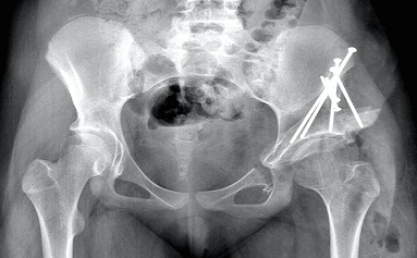 Doç. Dr. Güney YILMAZ, Serebral Palsi, Doğumsal Kalça Çıkığı, Gelişimsel Kalça Displazisi, Pavlik Bandaj Tedavisi, Kapalı/Açık Tedaviler, Ganz Osteotomisi, Femur Başı Epifiz Kayması, Perthes Hastalığı, Bacak Şekil Bozukluklarının Düzeltilmesi, Eksternal Fiksatörler, Kelepçe Sistemi, Büyüme Yönlendirme, Plak ve Vida Kullanımı, Kemik İçi Çivi Kullanımı, Bacak/Boy Uzatma Cerrahileri, Eksternal Fiksatörler, Kemik İçinden Manyetik Çivi, Pesekinovarus, Doğumsal Çarpık Ayak, Ponseti Yöntemi, Ayak Abdüksiyon Ortezi, Tendon Transferi, Düz Tabanlık, Osteogenesis İmperfekta, Cam Kemik Hastalığı, Teleskopik Çivi Uygulaması, Spina Bifida, İskelet Displazileri, Çocukluk Çağı Kas İskelet Sistemi Yaralanmalar