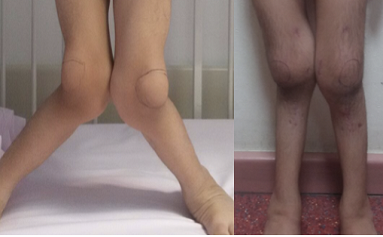 Doç. Dr. Güney YILMAZ, Serebral Palsi, Doğumsal Kalça Çıkığı, Gelişimsel Kalça Displazisi, Pavlik Bandaj Tedavisi, Kapalı/Açık Tedaviler, Ganz Osteotomisi, Femur Başı Epifiz Kayması, Perthes Hastalığı, Bacak Şekil Bozukluklarının Düzeltilmesi, Eksternal Fiksatörler, Kelepçe Sistemi, Büyüme Yönlendirme, Plak ve Vida Kullanımı, Kemik İçi Çivi Kullanımı, Bacak/Boy Uzatma Cerrahileri, Eksternal Fiksatörler, Kemik İçinden Manyetik Çivi, Pesekinovarus, Doğumsal Çarpık Ayak, Ponseti Yöntemi, Ayak Abdüksiyon Ortezi, Tendon Transferi, Düz Tabanlık, Osteogenesis İmperfekta, Cam Kemik Hastalığı, Teleskopik Çivi Uygulaması, Spina Bifida, İskelet Displazileri, Çocukluk Çağı Kas İskelet Sistemi Yaralanmalar