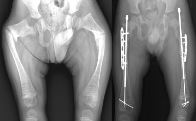 Doç. Dr. Güney YILMAZ, Serebral Palsi, Doğumsal Kalça Çıkığı, Gelişimsel Kalça Displazisi, Pavlik Bandaj Tedavisi, Kapalı/Açık Tedaviler, Ganz Osteotomisi, Femur Başı Epifiz Kayması, Perthes Hastalığı, Bacak Şekil Bozukluklarının Düzeltilmesi, Eksternal Fiksatörler, Kelepçe Sistemi, Büyüme Yönlendirme, Plak ve Vida Kullanımı, Kemik İçi Çivi Kullanımı, Bacak/Boy Uzatma Cerrahileri, Eksternal Fiksatörler, Kemik İçinden Manyetik Çivi, Pesekinovarus, Doğumsal Çarpık Ayak, Ponseti Yöntemi, Ayak Abdüksiyon Ortezi, Tendon Transferi, Düz Tabanlık, Osteogenesis İmperfekta, Cam Kemik Hastalığı, Teleskopik Çivi Uygulaması, Spina Bifida, İskelet Displazileri, Çocukluk Çağı Kas İskelet Sistemi Yaralanmalar