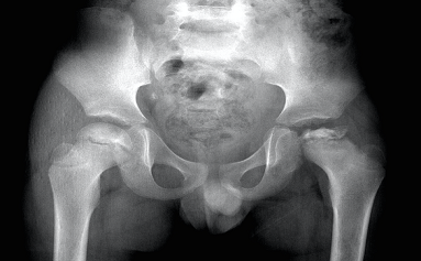 Doç. Dr. Güney YILMAZ, Serebral Palsi, Doğumsal Kalça Çıkığı, Gelişimsel Kalça Displazisi, Pavlik Bandaj Tedavisi, Kapalı/Açık Tedaviler, Ganz Osteotomisi, Femur Başı Epifiz Kayması, Perthes Hastalığı, Bacak Şekil Bozukluklarının Düzeltilmesi, Eksternal Fiksatörler, Kelepçe Sistemi, Büyüme Yönlendirme, Plak ve Vida Kullanımı, Kemik İçi Çivi Kullanımı, Bacak/Boy Uzatma Cerrahileri, Eksternal Fiksatörler, Kemik İçinden Manyetik Çivi, Pesekinovarus, Doğumsal Çarpık Ayak, Ponseti Yöntemi, Ayak Abdüksiyon Ortezi, Tendon Transferi, Düz Tabanlık, Osteogenesis İmperfekta, Cam Kemik Hastalığı, Teleskopik Çivi Uygulaması, Spina Bifida, İskelet Displazileri, Çocukluk Çağı Kas İskelet Sistemi Yaralanmalar